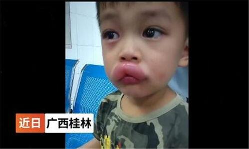 娱乐吃瓜酱过敏,吃瓜酱过敏背后的惊人真相
